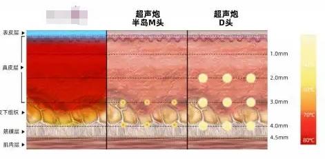 超声炮多久有成效?超声炮的原理、疗程等介绍!