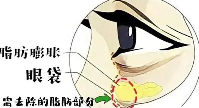 王健去眼袋怎么样?医生实力点评|真人案例图分享!