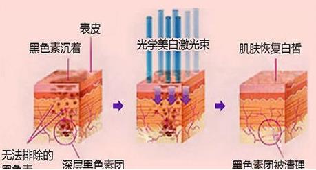 光子嫩肤一到七天图恢复过程:肌肤变得更光滑,毛孔也细腻~