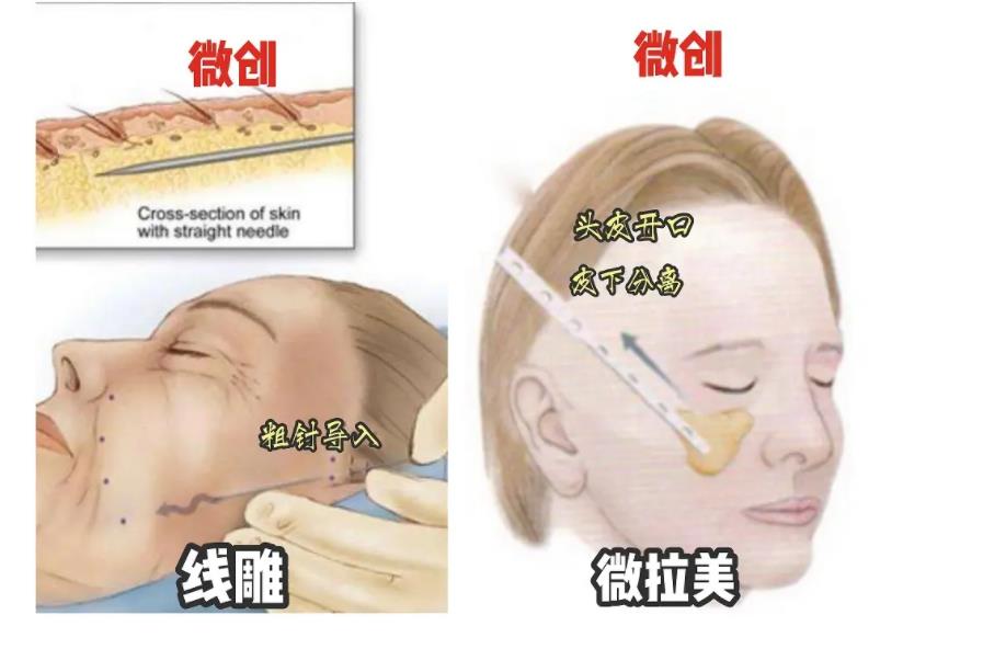 微拉美和拉皮的区别有什么?抗初老和深层次抗衰老~