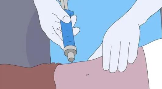 北京清华长庚医院陈强怎么样?吸脂瘦身手术案例分析!