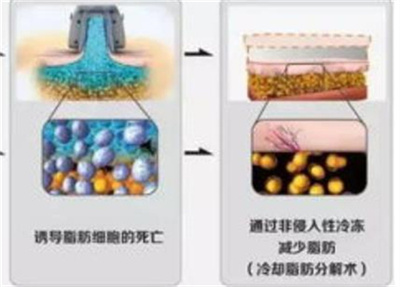 马桂娥吸脂好吗? 吸脂原理是什么?点进来查看