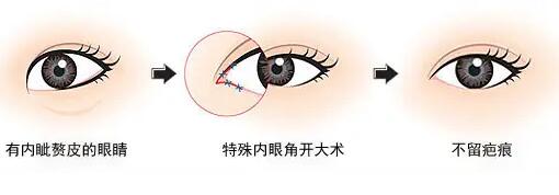 陈霞做内眼角开大好吗?效果怎么样?来看详细介绍
