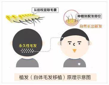 广州仁健植发怎么样?医院简介、头顶加密案例图、价格表