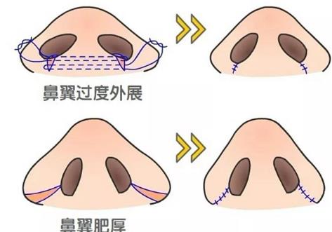 钟爱梅鼻翼缩小怎么样?钟医生做鼻子整形技术可不可靠?案例图曝光!