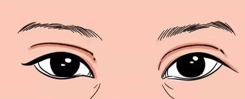 八大处杨喆医生双眼皮修复手术做的怎么样?真实眼部修复对比照曝光!