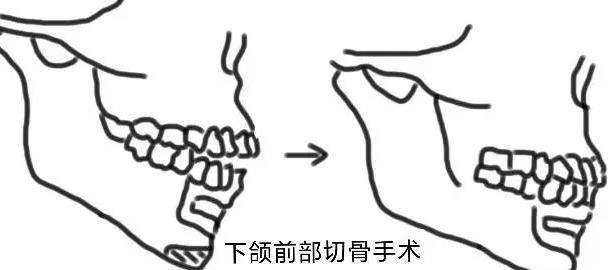 八大处杨喆正颌做的怎么样?杨医生个人技术优势介绍!正颌手术案例