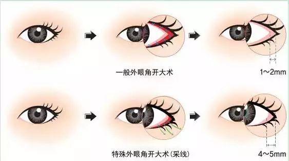 深圳美莱去眼纹怎么样?技术特色揭晓!医生信息附上~
