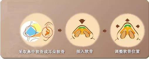 广州积美整形医院正规吗?怎么样?门诊口碑资历公开!隆鼻案例