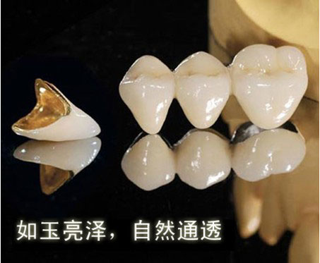 钛合金烤瓷牙多少钱一颗?对身体有害吗?修复牙知识点~