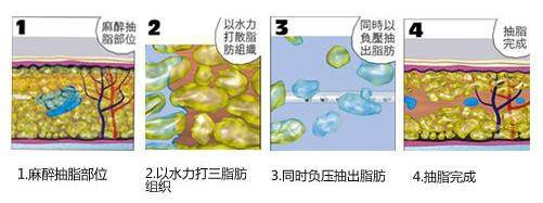 抽脂手术对身体有什么副作用?出xue、神经麻痹等,80%的人不知道!