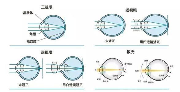 上班族近视激光手术好吗?多少钱?价格表_原理抢先看!