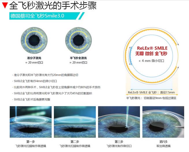 上班族近视激光手术好吗?多少钱?价格表_原理抢先看!