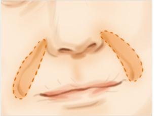 艾莉薇玻尿酸能保持多久?适合注射哪些部位?内轮廓固定选ta~