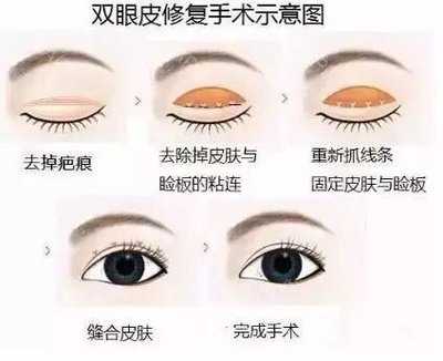 苏薇洁做双眼皮修复吗?多少钱一次?医生技术\收费标准