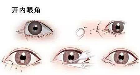 开眼角多少钱?价格费用_恢复期_风险_术后护理