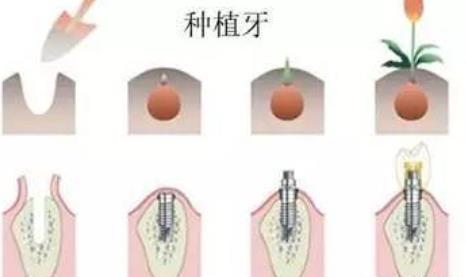 上海茂菊种植牙价格表曝光!医院基本资料介绍!牙齿种植过程图介绍