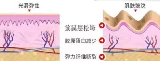 热玛吉的功效作用及副作用汇总!含维持时间、价格费用