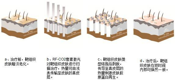 激光点痦子会留疤吗?原理、优势、术后护理盘点