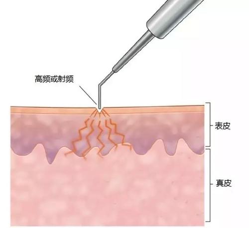 激光点痦子会留疤吗?原理、优势、术后护理盘点