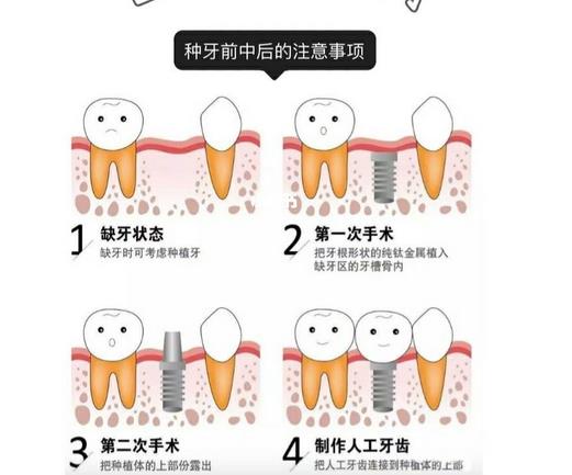 北京臻齿口腔种牙怎么样？院内资料\种牙案例\价格费用