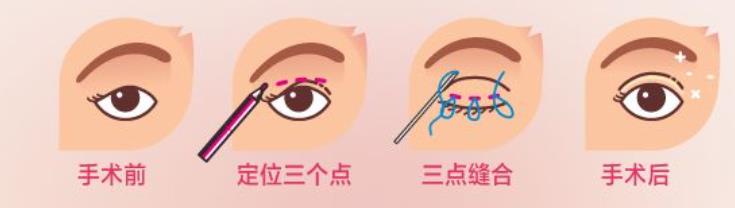 屈晶教授做双眼皮怎么样?坐诊医院基本资料介绍!案例介绍