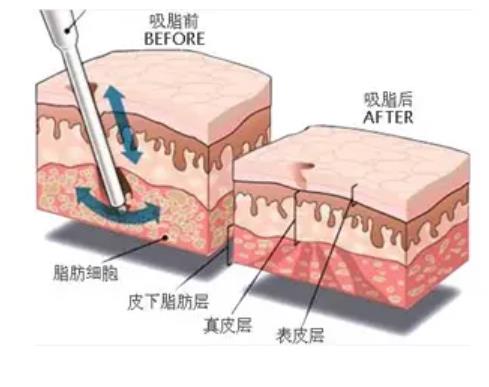 袁玉坤吸脂案例曝光!真人做吸脂手术前后对比照大公开!