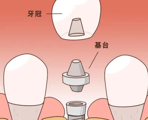 上海德信会口腔门诊部种植牙多少钱?真人案例:效果真心不错!