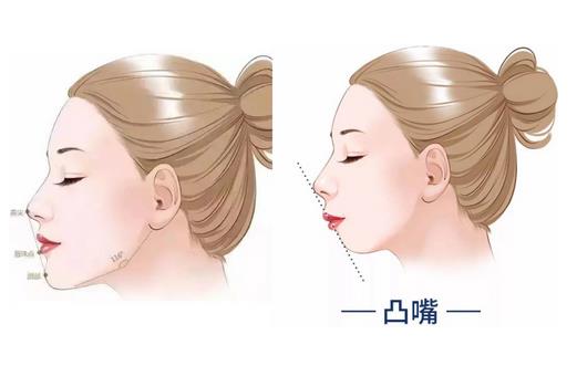 上海时光做凸嘴正颌手术需要多少钱?案例展示,附价格表可参考