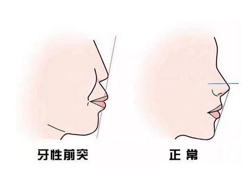 上海时光做凸嘴正颌手术需要多少钱?案例展示,附价格表可参考