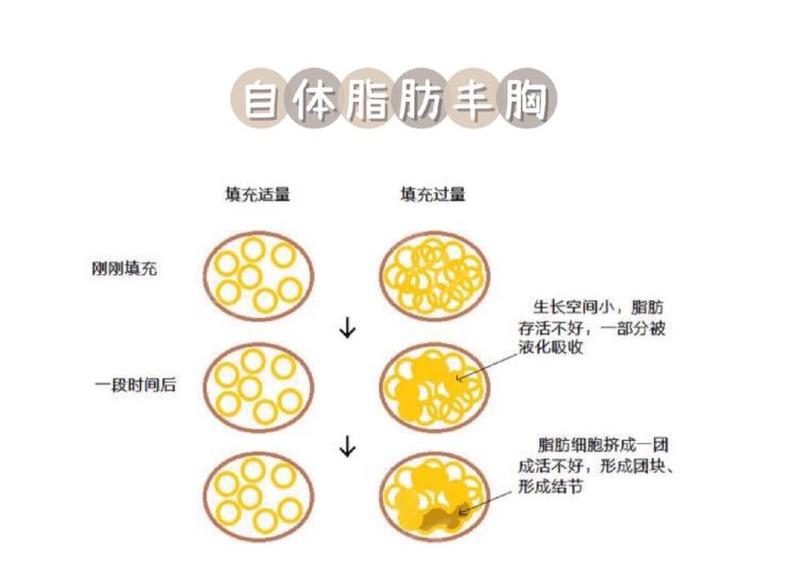 米兰柏羽宋子杰医生怎么样?技术水平展现!文末有案例