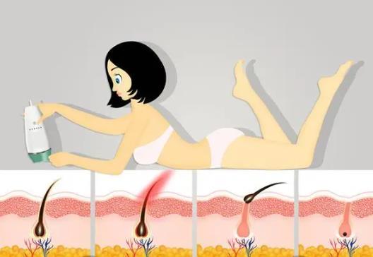 广州者梵整形医院正规吗?仵伟医生个人技术特色分析!脱毛效果图