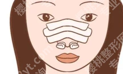 上海圣娅医疗美容医院杨明做鼻子怎么样?技术特色分析!术后效果图曝光