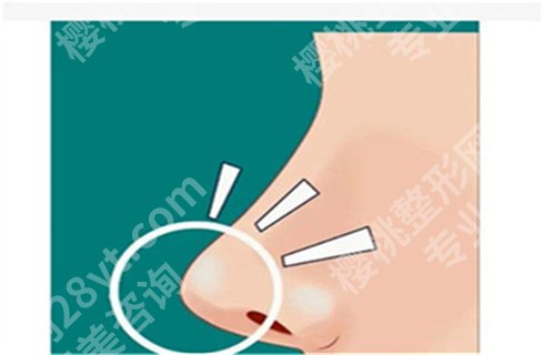 上海艺星许炎龙做的鼻子图片分享,技术可靠吗?速来围观!