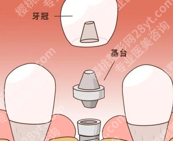 上海蓝馨口腔门诊种植牙怎么样?网友亲身经历分享:公布恢复过程!