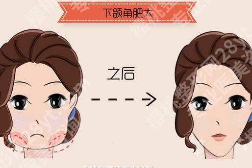 上海何晋龙磨骨怎么样?真实案例在线点评,价格表参考