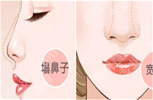 邱文苑隆鼻风格自然吗?医生详情,赶紧来了解!