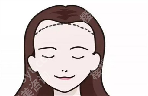 张久赋医生评价!口碑、实力双优,鬓角种植案例