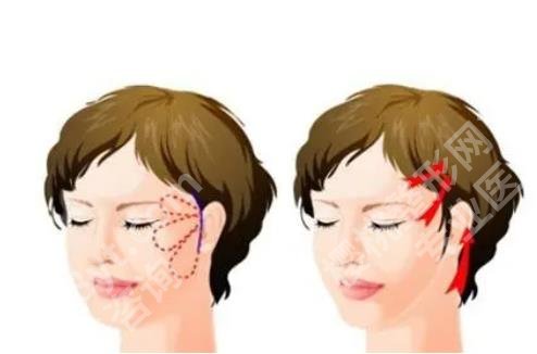 上海华美玻尿酸价格多少?哪个医生技术好?玻尿酸注射案例