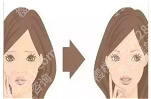 上海华美玻尿酸价格多少?哪个医生技术好?玻尿酸注射案例