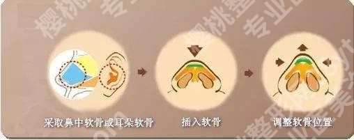 上海圣娅医疗美容医院魏少魁医生技术怎么样?个人简介、隆鼻案例一览