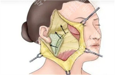 上海琥裳医疗吴佳君拉皮技术怎么样?案例前后对比图,价格表