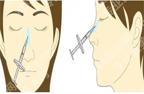 上海美莱游远榕做的鼻子图片分享!技术测评,案例详情一览