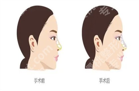 上海艺星许炎龙院长做鼻子怎么样?案例看手术风格,收费表