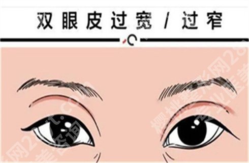 上海杨国正和杨亚益医生哪个双眼皮做的好?杨国正医生案例参考