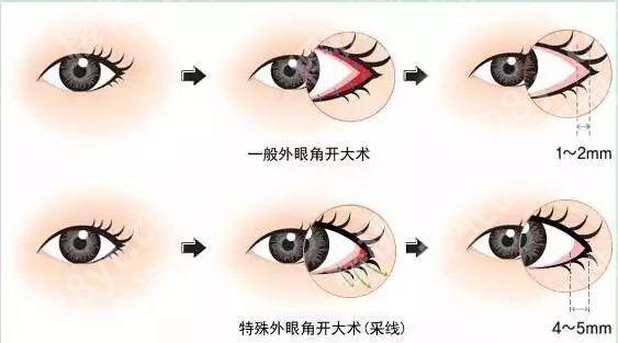上海柏荟医疗美容医院怎么样?口碑简介、网友开眼角案例图!