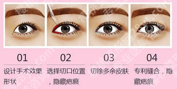 上海柏荟医疗美容医院怎么样?口碑简介、网友开眼角案例图!