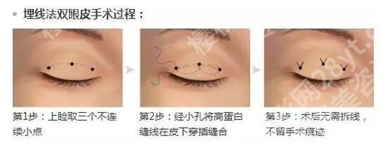 上海禾新医院医疗美容科双眼皮怎样?技术优势、案例反馈来袭!