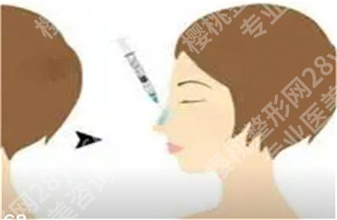 上海曹芳鼻子做的怎么样?隆鼻技术好吗?附隆鼻案例