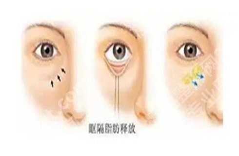 朴相根双眼皮修复案例?医生技术实力怎么样?附价格表